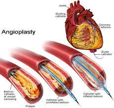 Angioplasty procedure - what is, risks and outloock