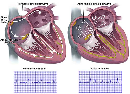 Atrial Fibrillation - what is, symptoms, tretament and causes