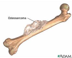 Bone Cancer Of The Spine Prognosis
