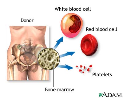 http://www.beltina.org/pics/bone_marrow_transplantation.jpg