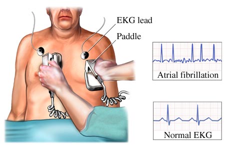 Cardioversion (electrical) procedure - what is and definition