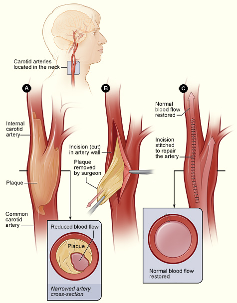  ARTERY in the neck due to ATHEROSCLEROSIS. Often carotid stenosis shows 