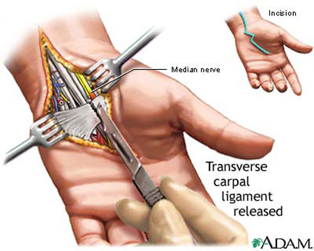 Carpal Tunnel Syndrome - treatment, symptoms, exercises and surgery