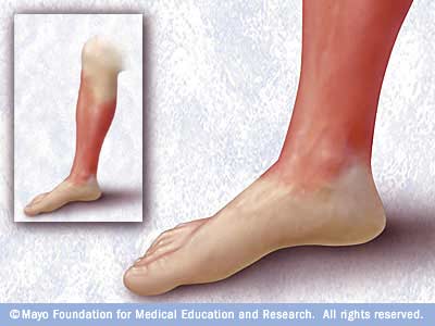 Cellulitis Is Inflammation Of The Inner Layers Of The Skin And The