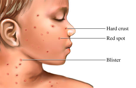 onset of chickenpox. What is Chickenpox