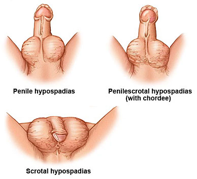 Chordee is a congenital present at birth downward curvature of the PENIS