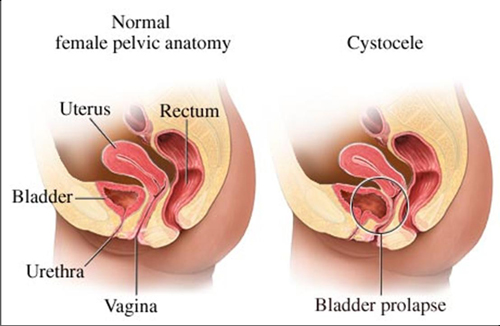 Cystocele - symptoms, treatment, repair and surgery