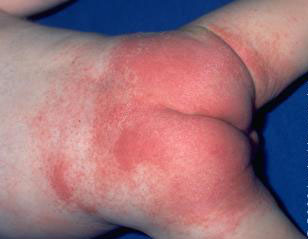 Diaper Rash - definition and treatment