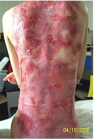 Epidermolysis Bullosa - types, symptoms and treatment