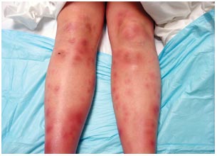 Erythema Nodosum - symptoms and treatment