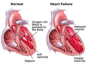 Heart failure - symptoms and treatment