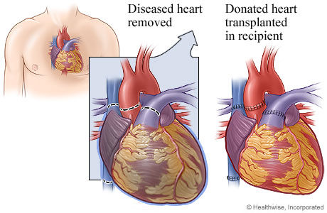 What is HEART TRANSPLANT