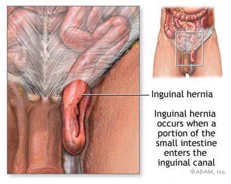 Hernia In Penis 94