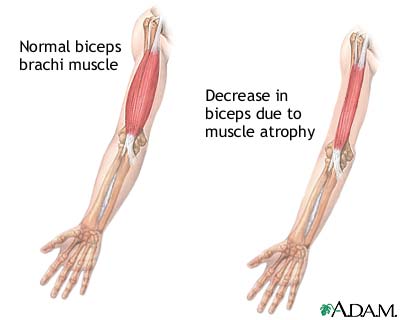 What are signs of muscular dystrophy?