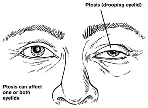 Myasthenia Gravis - symptoms and treatment