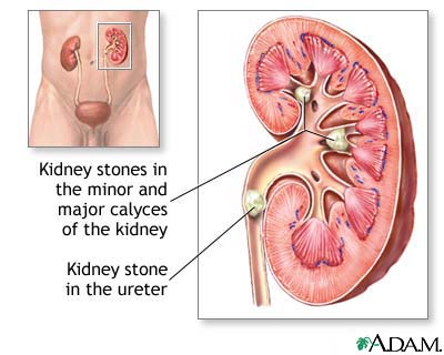 nephrolithiasis What Are Kidney Stones From