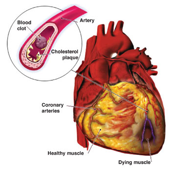 Obesity and Cardiovascular Disease