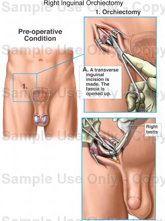 Orchiectomy procedure risks and side effects
