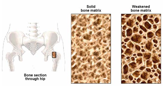 Osteoporosis X Ray. (X-RAY based) bone density