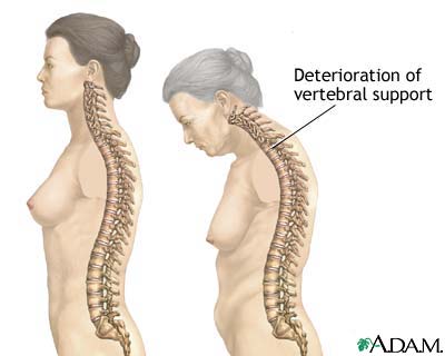 Osteoporosis - definition, symptoms, treatment and medications