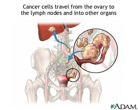 Ovarian Cancer - symptoms, signs, stages, diagnosis and treatment