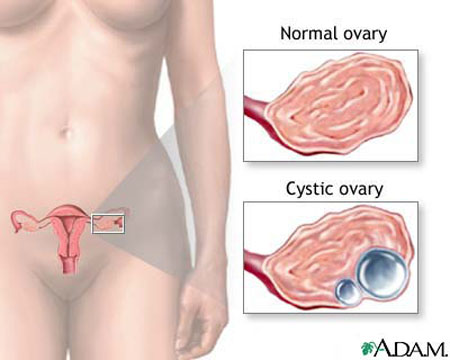 Ruptured Ovarian Cyst. Ovarian Cyst - symptoms