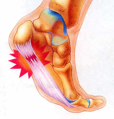 Plantar fasciitis - symptoms and treatment