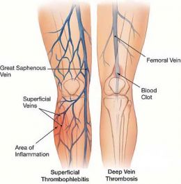 Varicose Veins - symptoms, treatment and laser surgery
