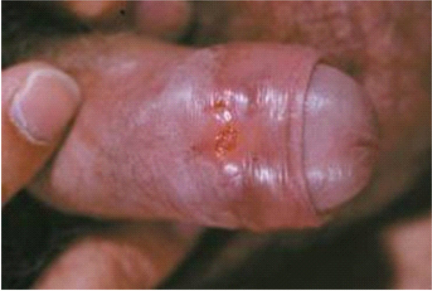 Lymfogranuloma venereum 