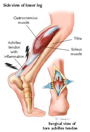 Achilles Tendon Injury - pain, rupture, treatment, repair and surgery
