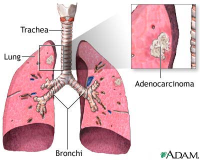 Adenocarcinoma (type of cancer)