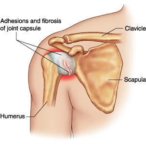 Adhesive Capsulitis shoulder - symptoms, treatment and surgery