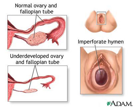 Amenorrhea - definition, primary and secondary Amenorrhea