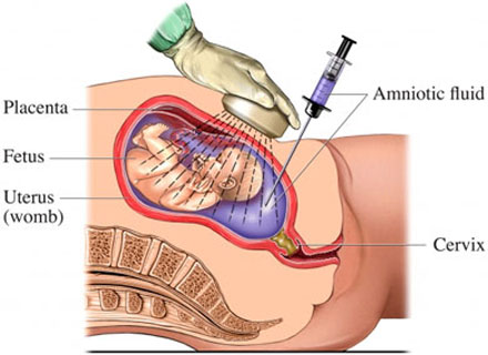 Amniocentesis procedure / test and Risks