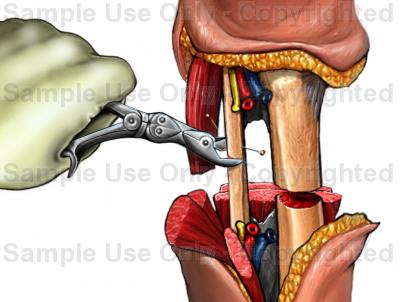 Amputation procedure - surgery, rehabilitation, complications and risks