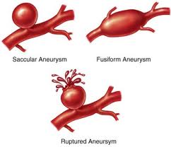 Aneurysm definition and symptoms