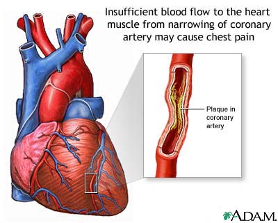 Angina Pectoris - Definition, Symptoms and Treatment