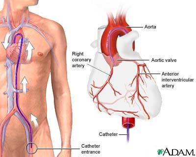 Angiogram - procedure and risks