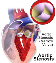 Aortic Stenosis - Symptoms and Treatment