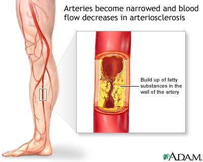 Arteriosclerosis definiiton