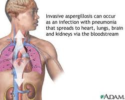 Aspergillosis - symptoms and treatment