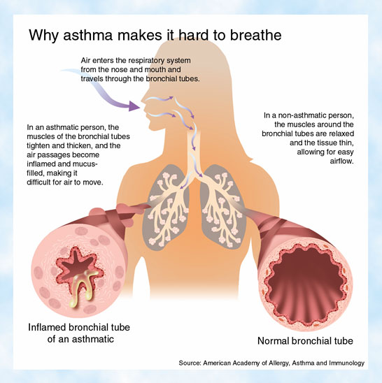 Asthma - symptoms, treatment and medications