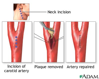 Atherectomy - surgical procedure