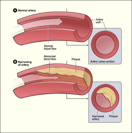 Atherosclerotic plaques