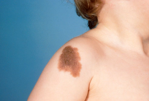 Birthmark - types, symptoms, removal and treatment
