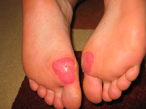 Blister - what is and treatment