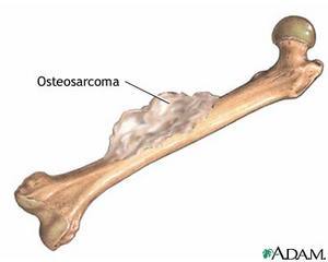 Bone Cancer - symptoms, prognosis, treatment and survival rate