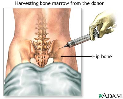 Bone marrow donation procedure