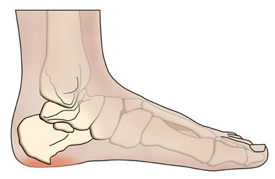 Bone Spur / osteophyte - extension of bone tissue - definition and treatment