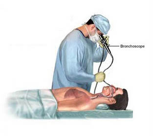 Bronchoalveolar lavage and Bronchoscopy